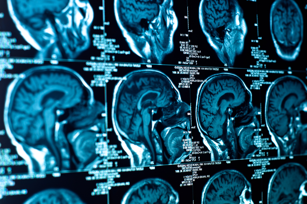 Traumatic Brain Injury Lawyer